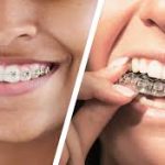 Understanding Invisalign Pain Management and What Discomfort Really Means During Tooth Movement