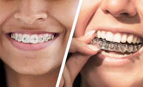 Understanding Invisalign Pain Management and What Discomfort Really Means During Tooth Movement